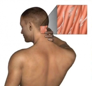 Adhesions fascial